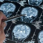 Erkeklerde gizlenmiş tehlike! Alzheimer araştırmasında, genetik varyantın demans riskini arttırdığı keşfedildi: bu varyantlı erkeklerde gelişme riskinin 2.39